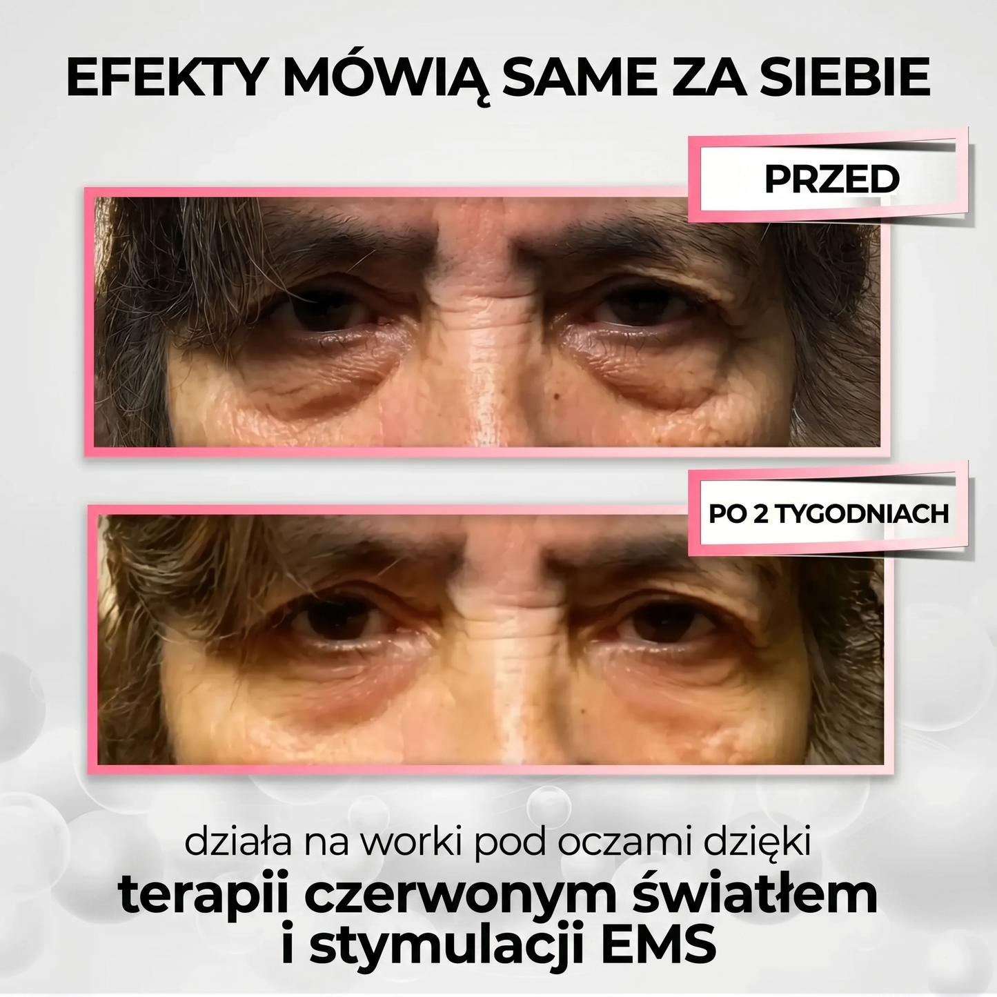 LumiEye Pro™ 2w1 - terapia czerwonym światłem + EMS na worki pod oczami